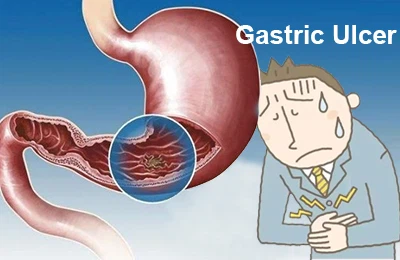 Inhibition of gastric ulcer
