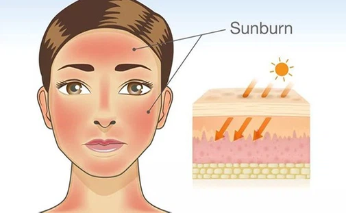 sunburn sunburn