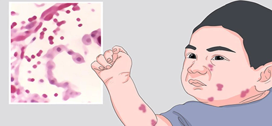 Skin infection Skin infection